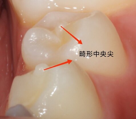 乳牙根管数量形态图片