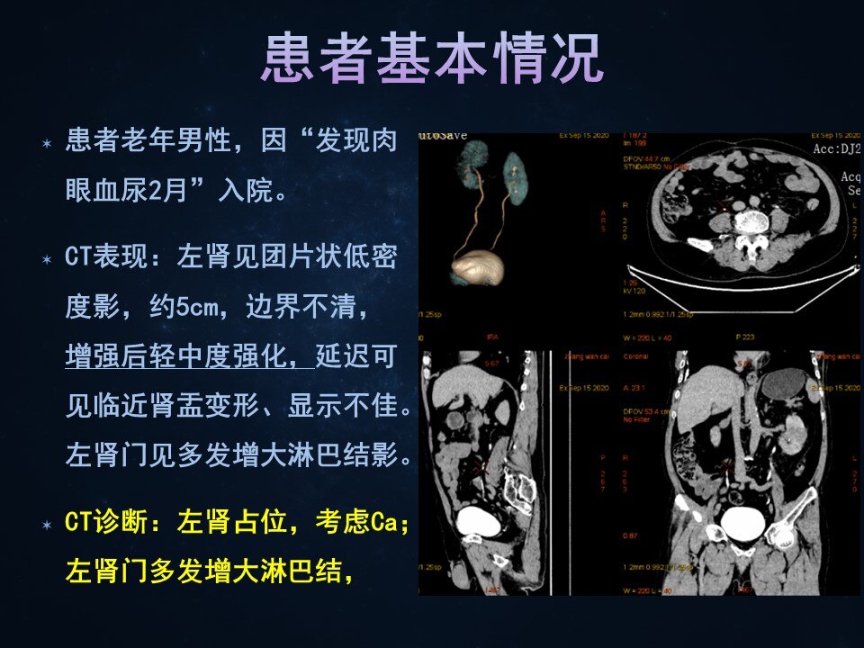 典型病例2:左肾盂癌合并腹膜后淋巴结转移 