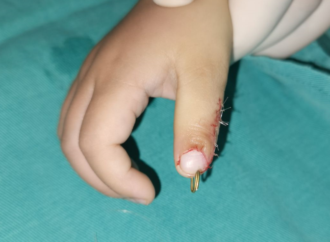 小孩先天性手足畸形,手术是不是越早做就越好?