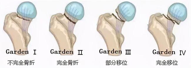 老年人,当心股骨颈骨折和股骨转子间骨折,也称"最后一次骨折"_股骨颈