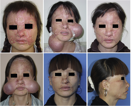 在颈部埋置扩张器修复面部瘢痕的方法(一)_疤痕_疤痕治疗方式 - 好