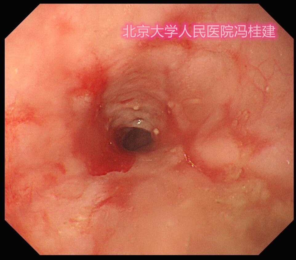 贲门失弛缓术后吞咽困难一定是复发吗