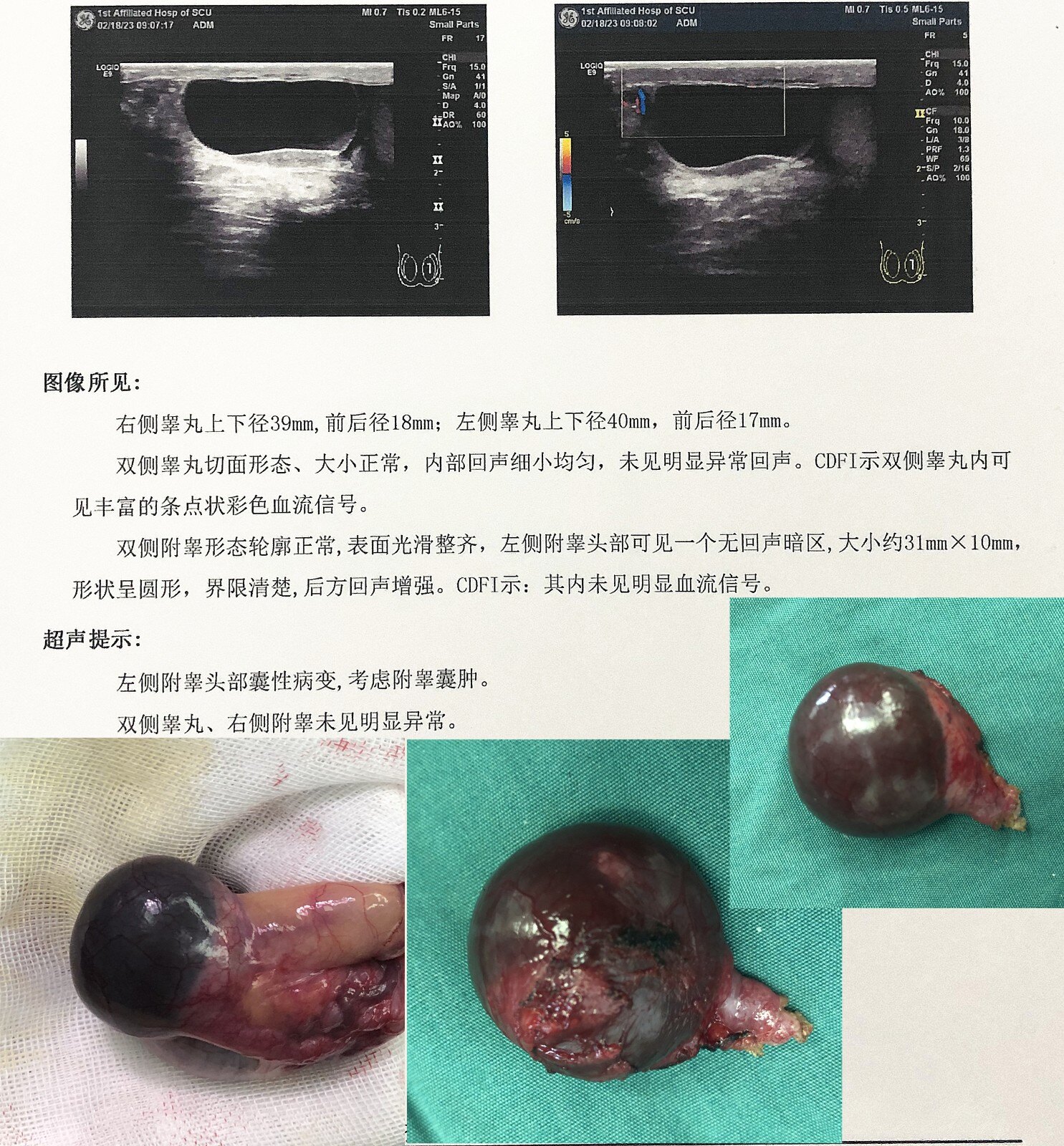 阴囊内肿块图片