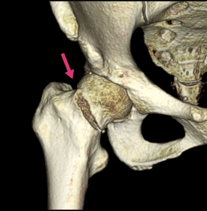 股骨颈骨折基底图片