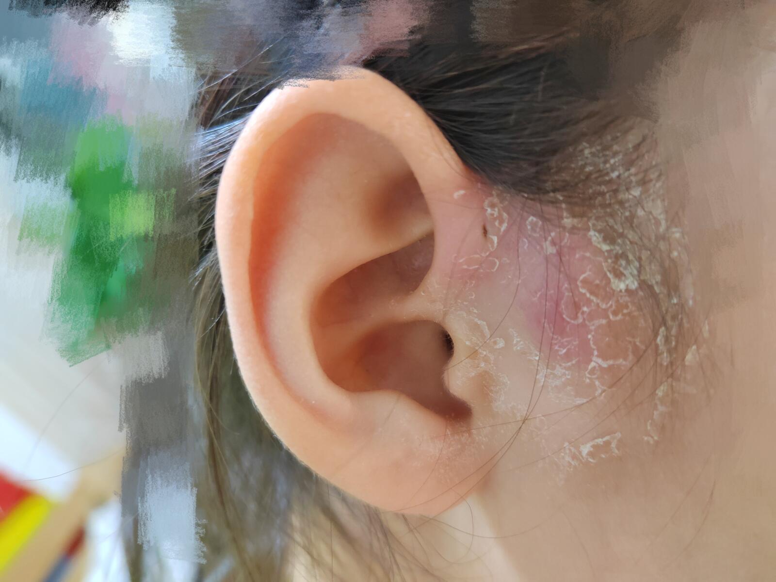 耳前瘘管发炎引流切除 - 知乎