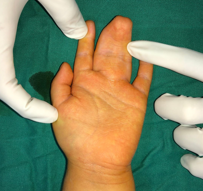 并指畸形常见问题解答及【手术案例合集】