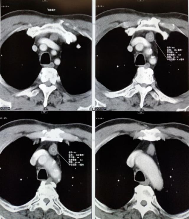 胸腺法新 肿瘤图片