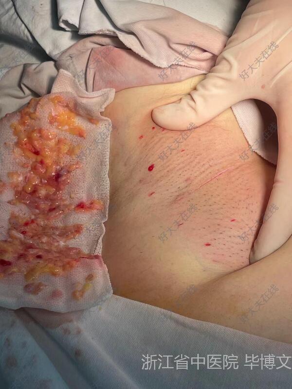 腋臭手术取出的图片图片