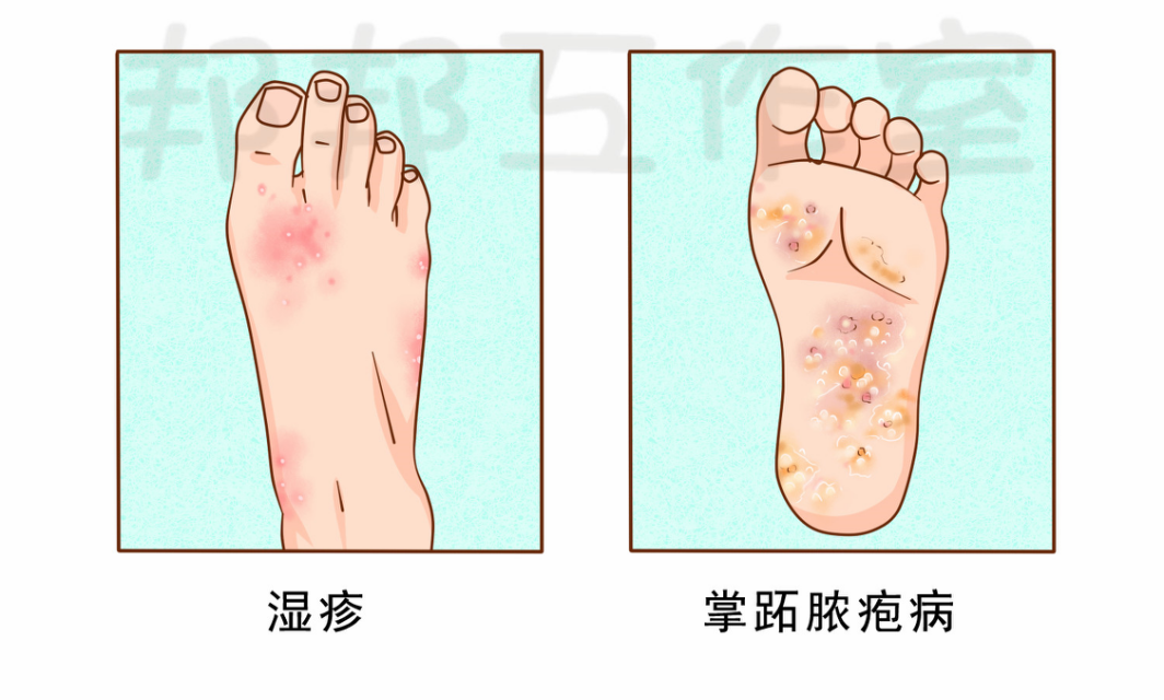 常常由于病程长久或反复治疗,导致皮损不典型,难以单凭临床症状同脚气