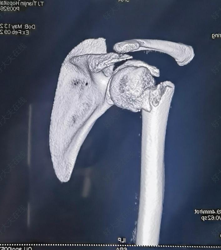 肱骨近端骨骺滑脱