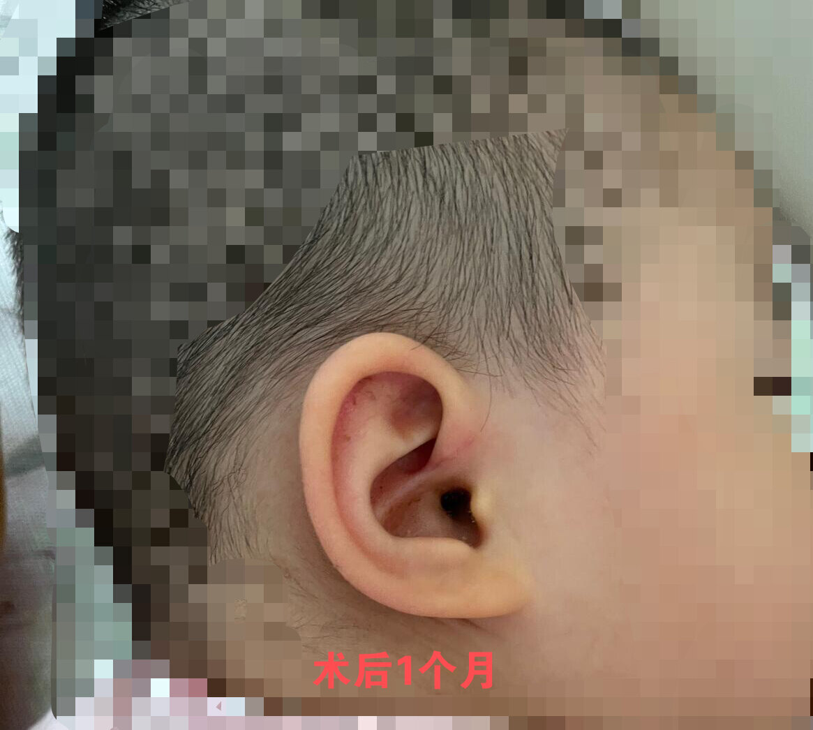 左耳介・耳垂ケロイド切除術 - 美容外科・形成外科 | ジョイアクリニック京都 | 京都・烏丸御池