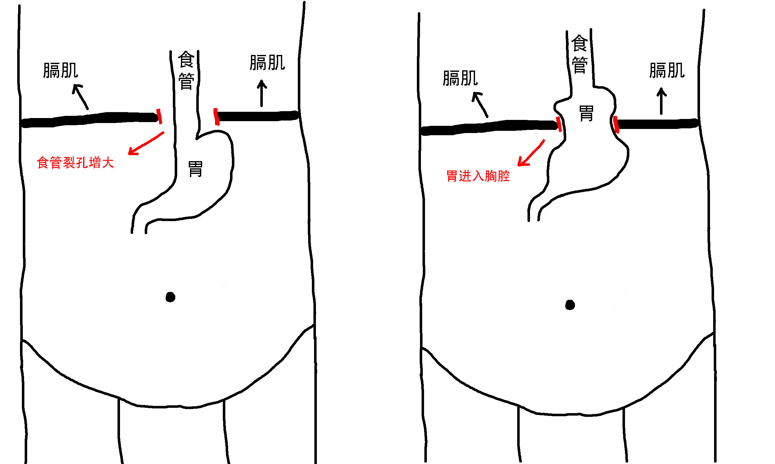 食管裂孔疝-3.jpg