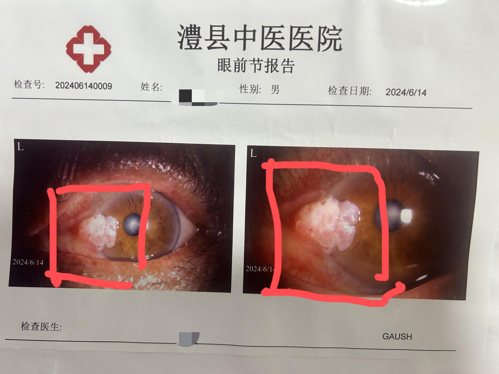 眼睛里面长疙瘩,小心恶性肿瘤