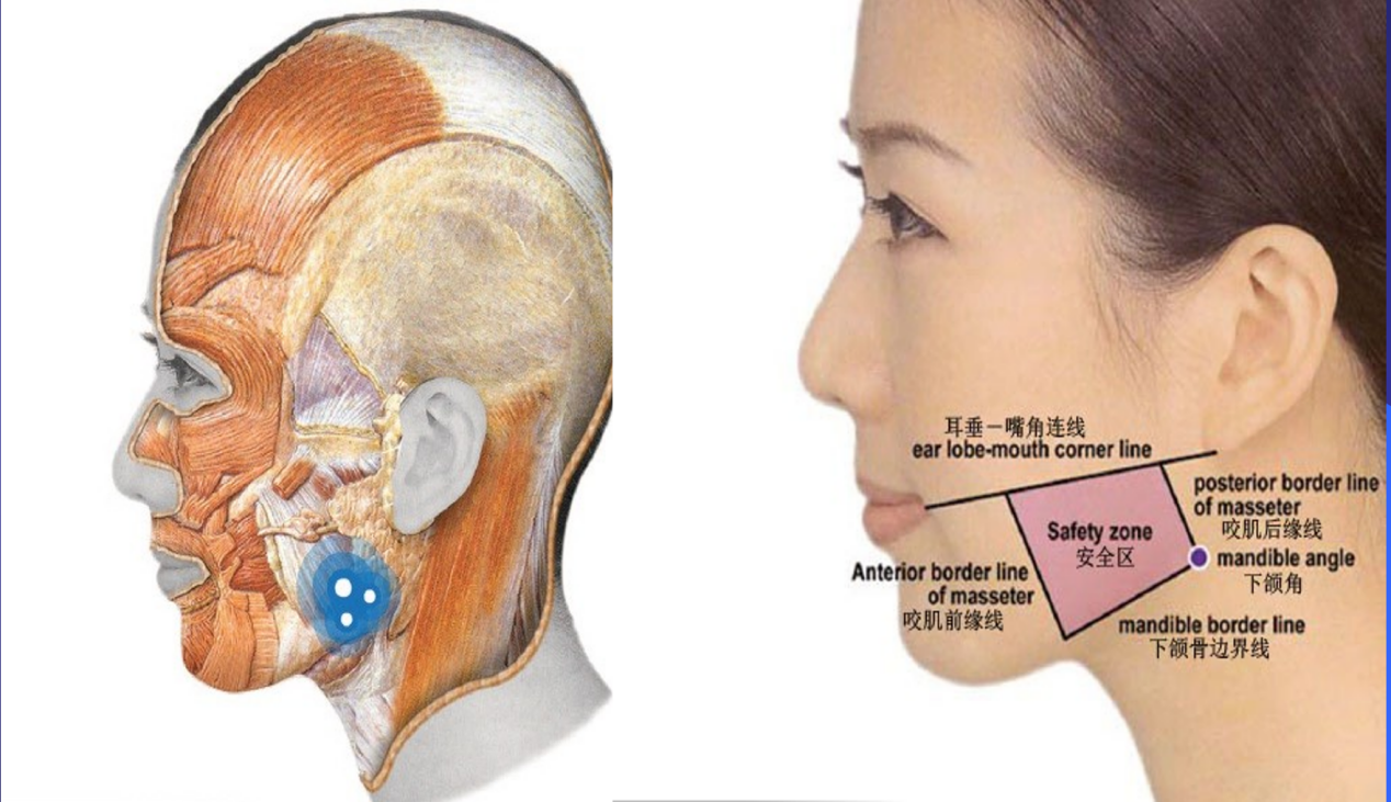a型肉素毒注射之肌肉篇_瘦脸针_瘦脸针治疗介绍 - 好大夫在线