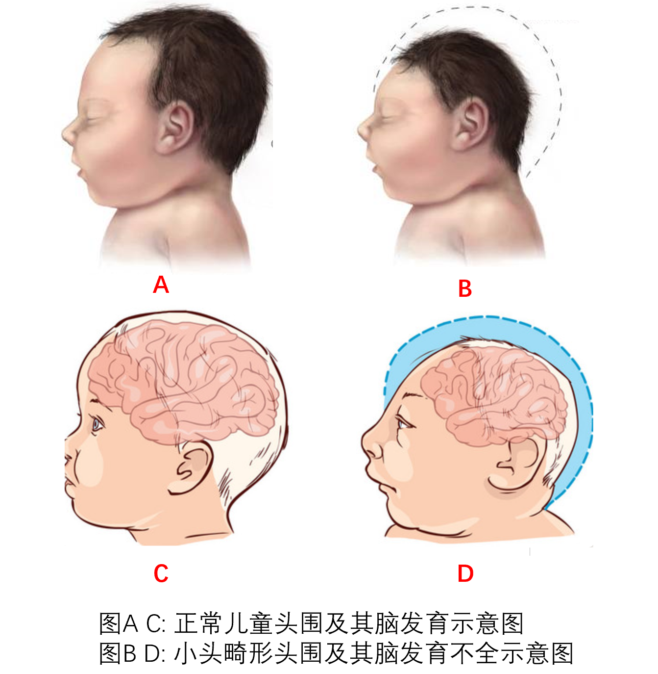 小头畸形婴儿面部特征图片