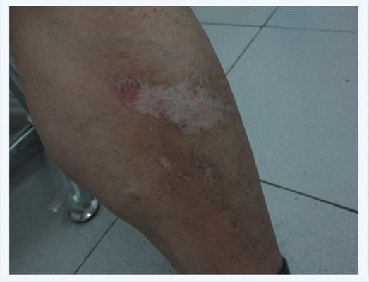 烫伤疤痕颜色变黑了怎么办 疤痕 烫伤疤痕颜色变黑了怎么办 疤痕