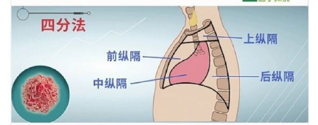 (6)25%-75%胸腺瘤患者有重症肌無力症狀.