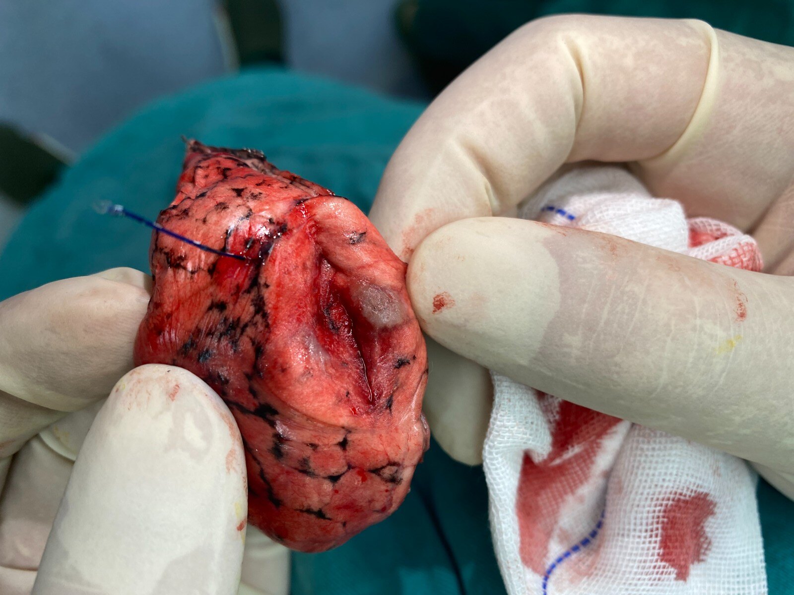 肺磨玻璃结节的定位方法,有图有真相 - 好大夫在线