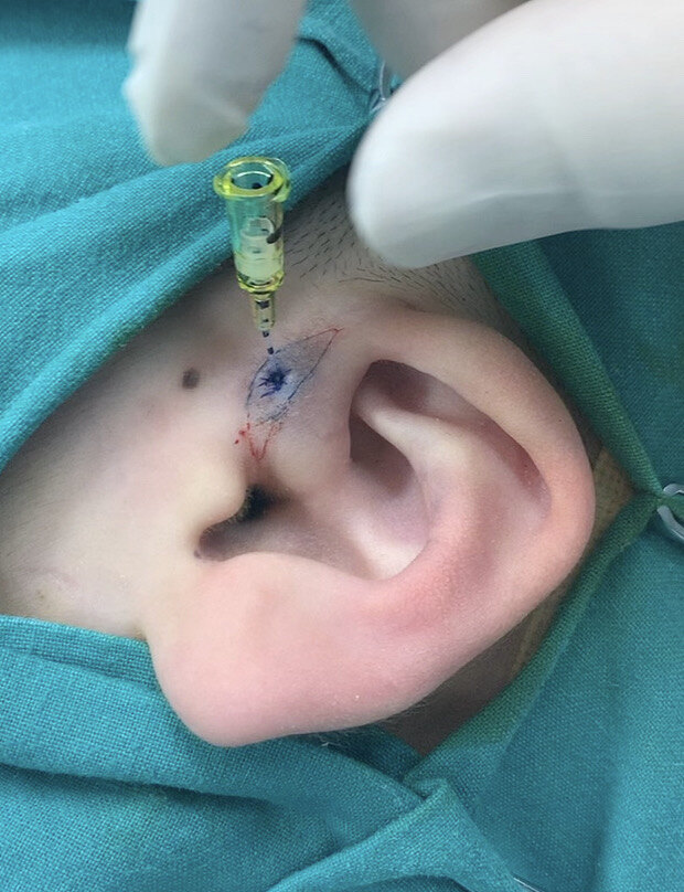 耳前瘘管手术