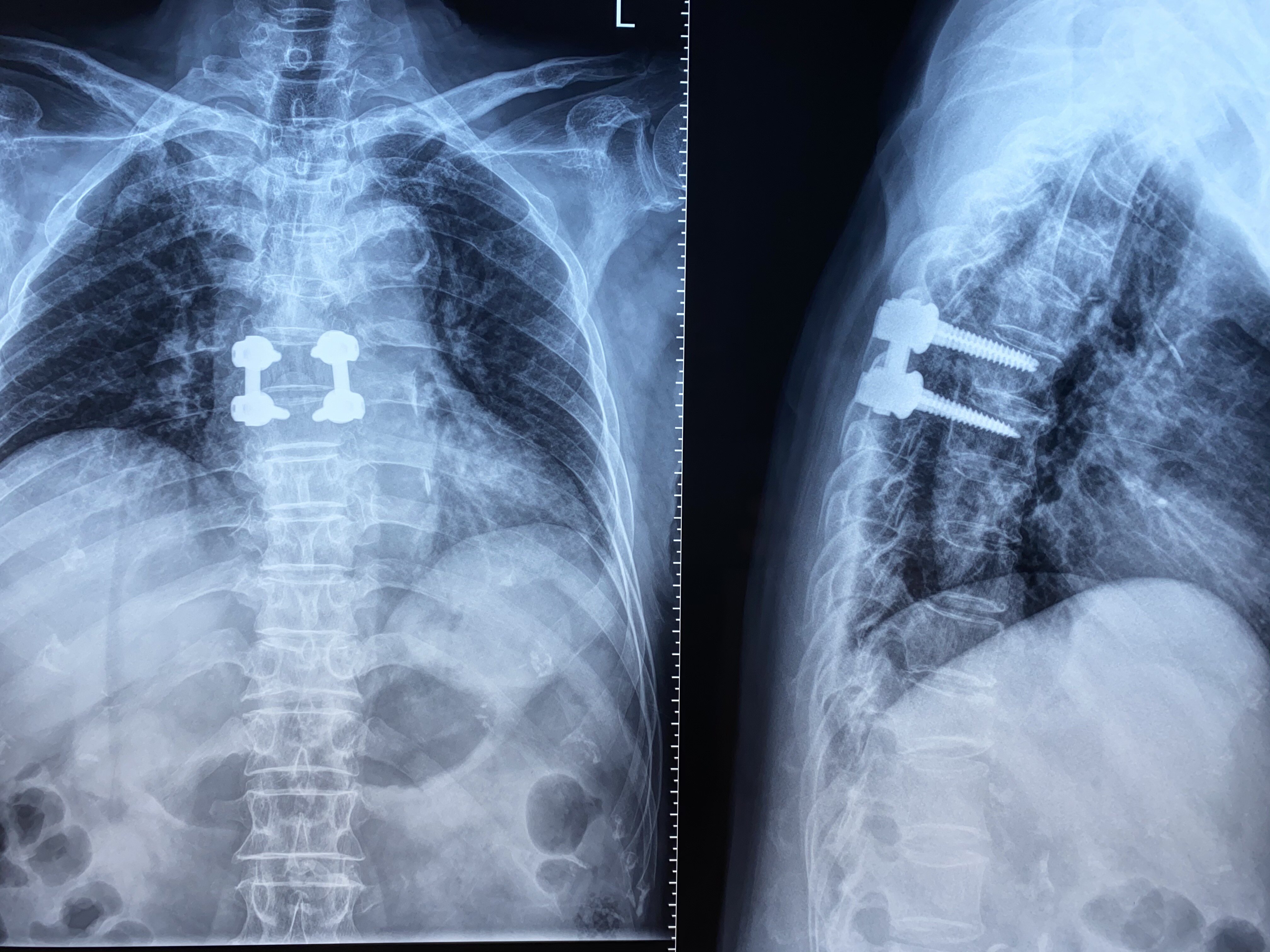 胸椎管内肿瘤完整摘除 - 好大夫在线