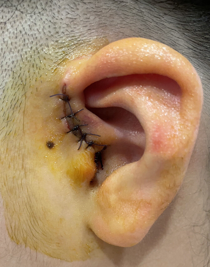 先天性耳前瘘管发病率图片