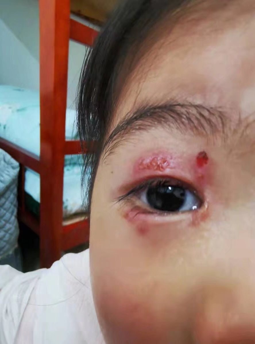 眼单纯疱疹病毒性眼睑皮炎