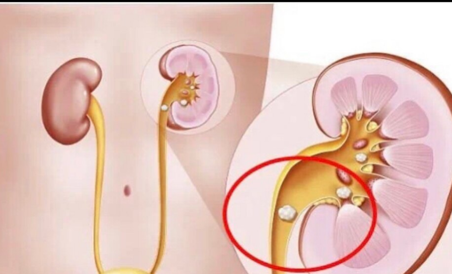 腎輸尿管結石示意圖膀胱腫瘤ct膀胱腫瘤(術中所見)膀胱腫瘤(激光塊狀