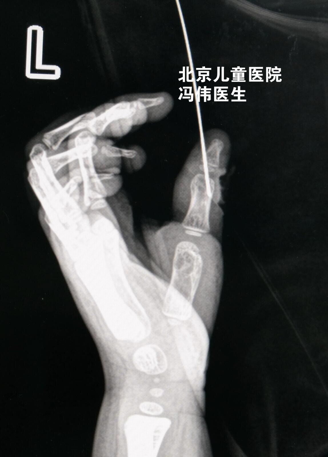 拇指畸形再建矫形术最新方法——SMRT漂浮拇重建术 - 知乎