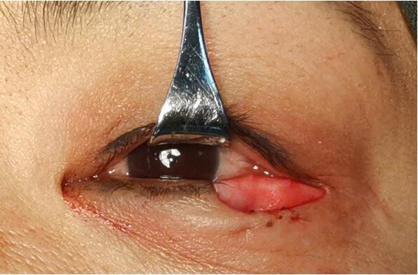 眼部肿瘤科普系列之 眼睑恶性肿瘤