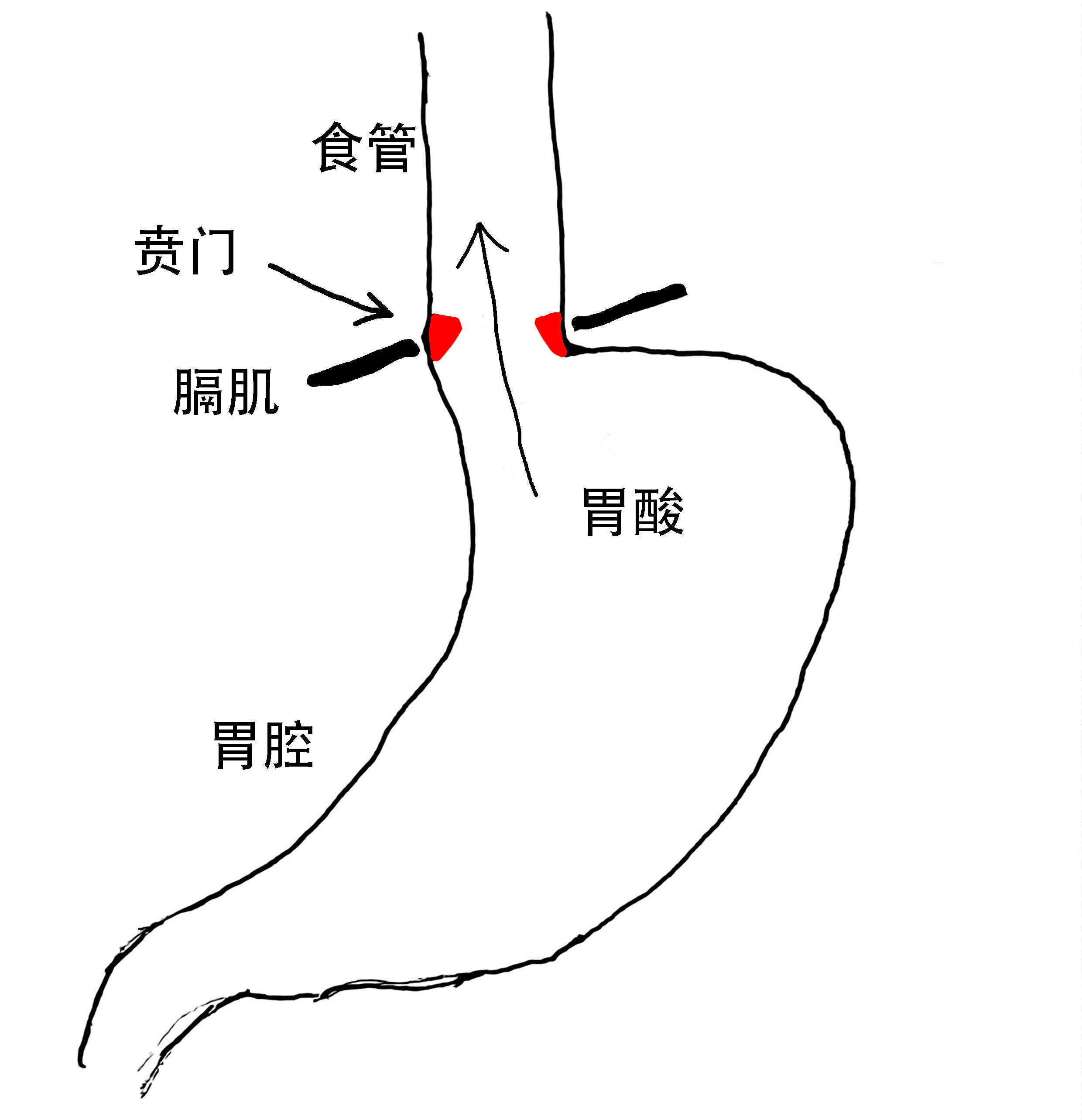 贲门示意图_1副本.jpg