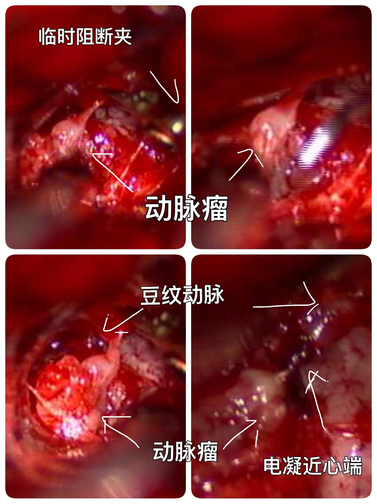 成功治疗罕见豆纹动脉动脉瘤-窦以河-青大附院 - 好大夫在线