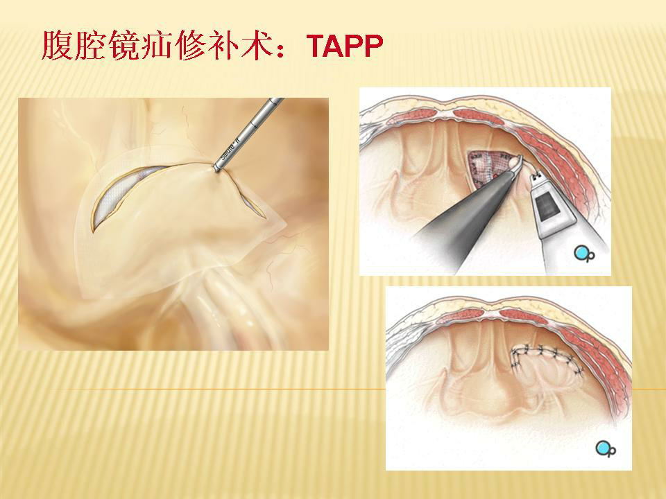 1990年schultz等报告经腹腔镜下行腹膜前疝修补术(tapp术).