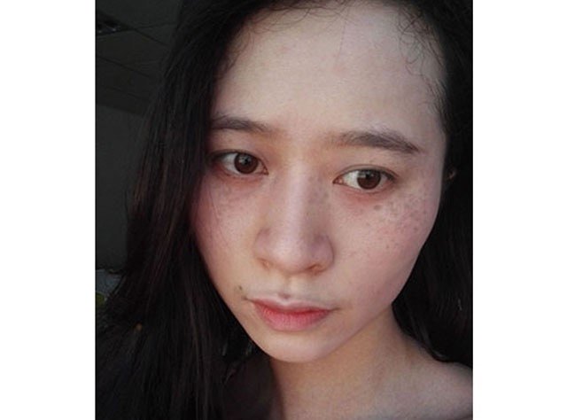 史上最强的色斑知识大全! - 好大夫在线