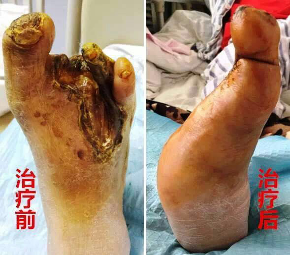 糖尿病患者如何保护好您的脚