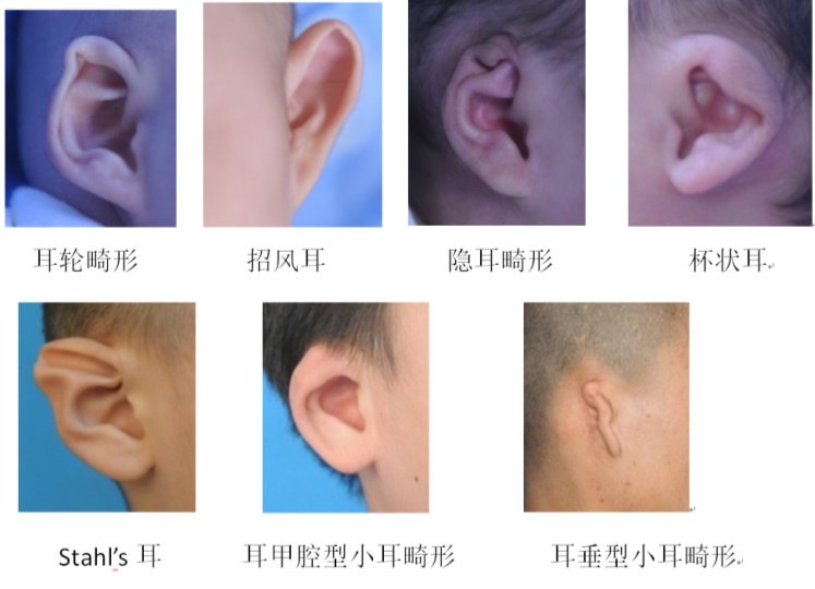 耳朵畸形怎么治疗图片