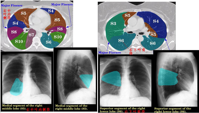 看完這些圖你就能看懂肺部ct