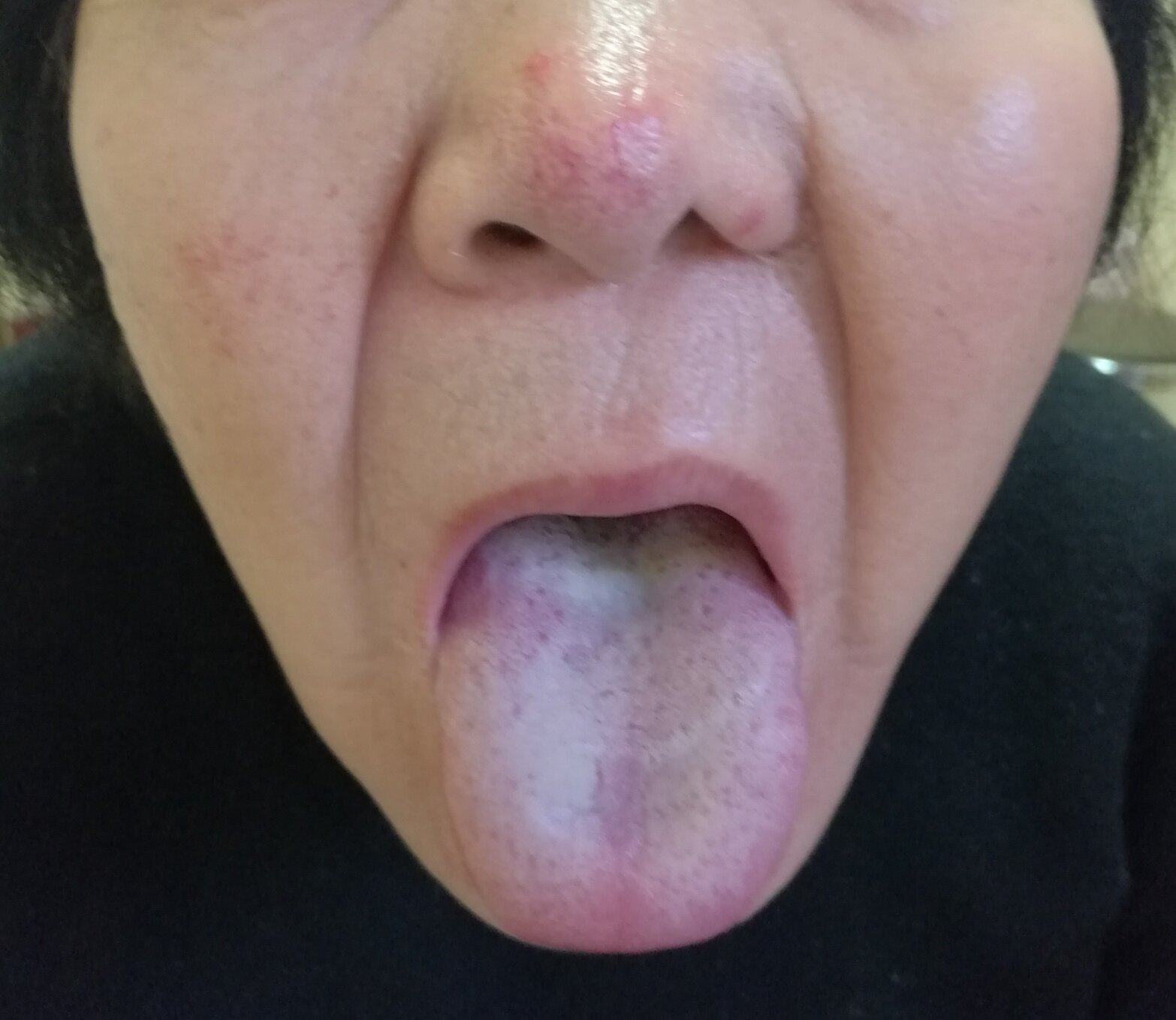 图1女56岁神经症,红舌燥涩苔,治疗难度大