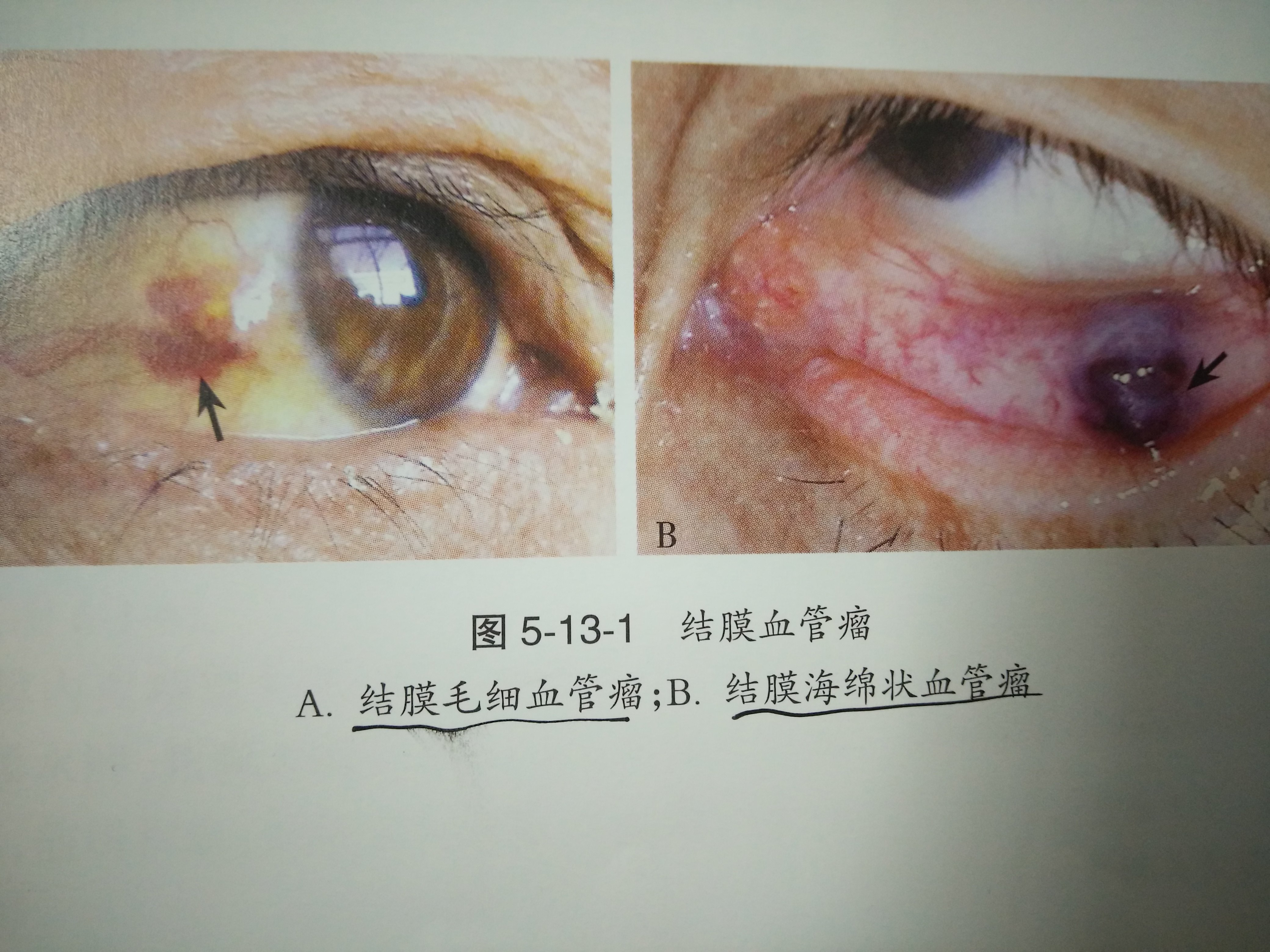 眼海绵状血管瘤图片