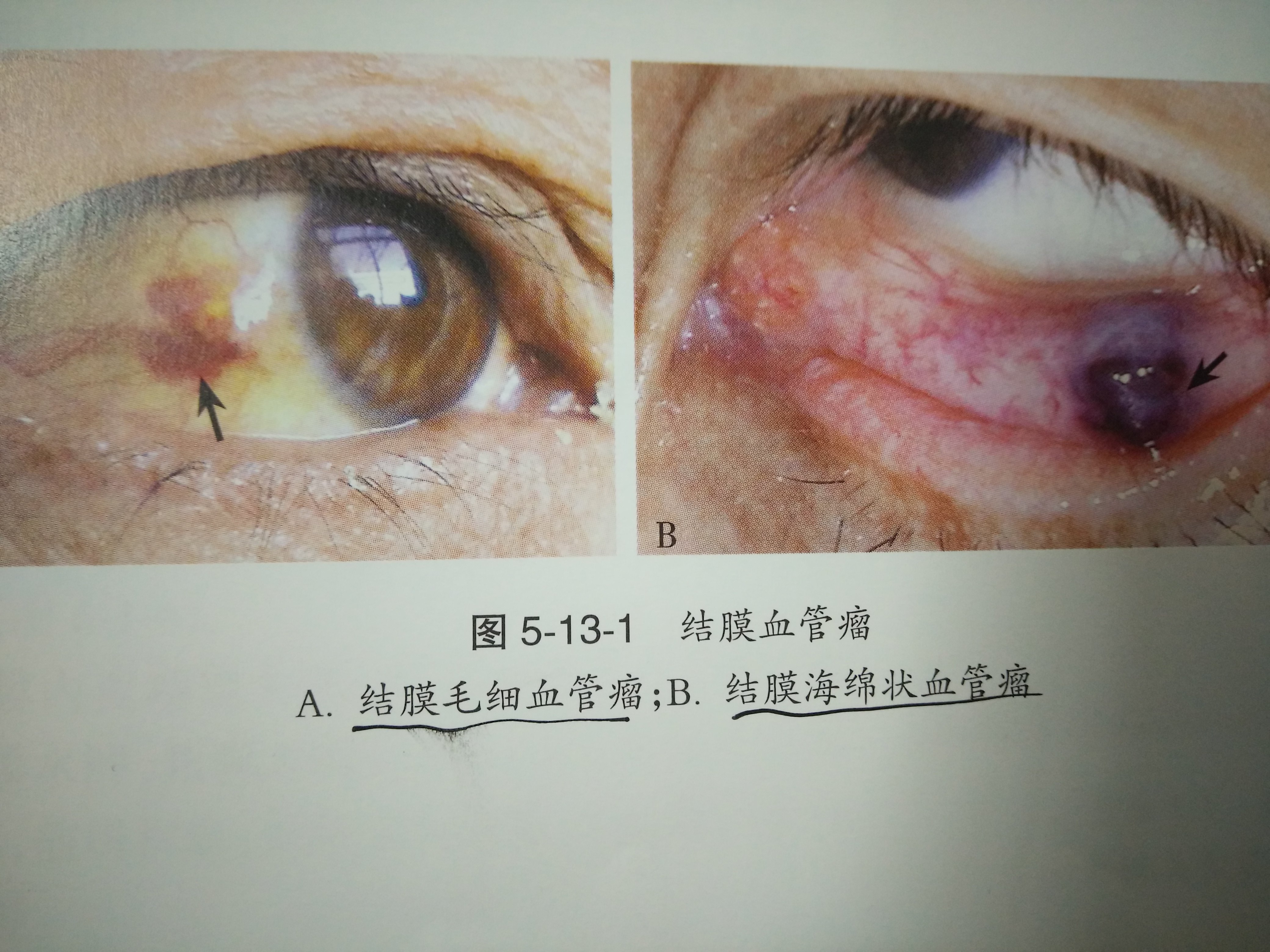 结膜血管瘤的表现 结膜血管瘤 结膜血管瘤 结膜血管瘤的表现 结膜血管瘤 结膜血管瘤