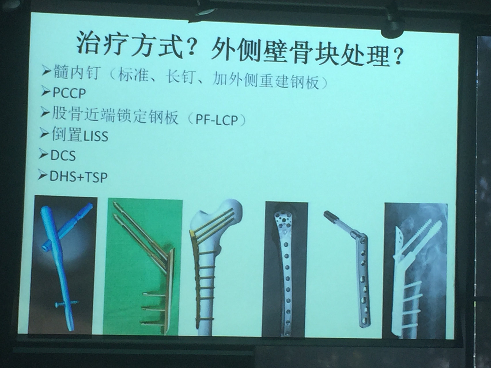 多数情况下选择髓内钉