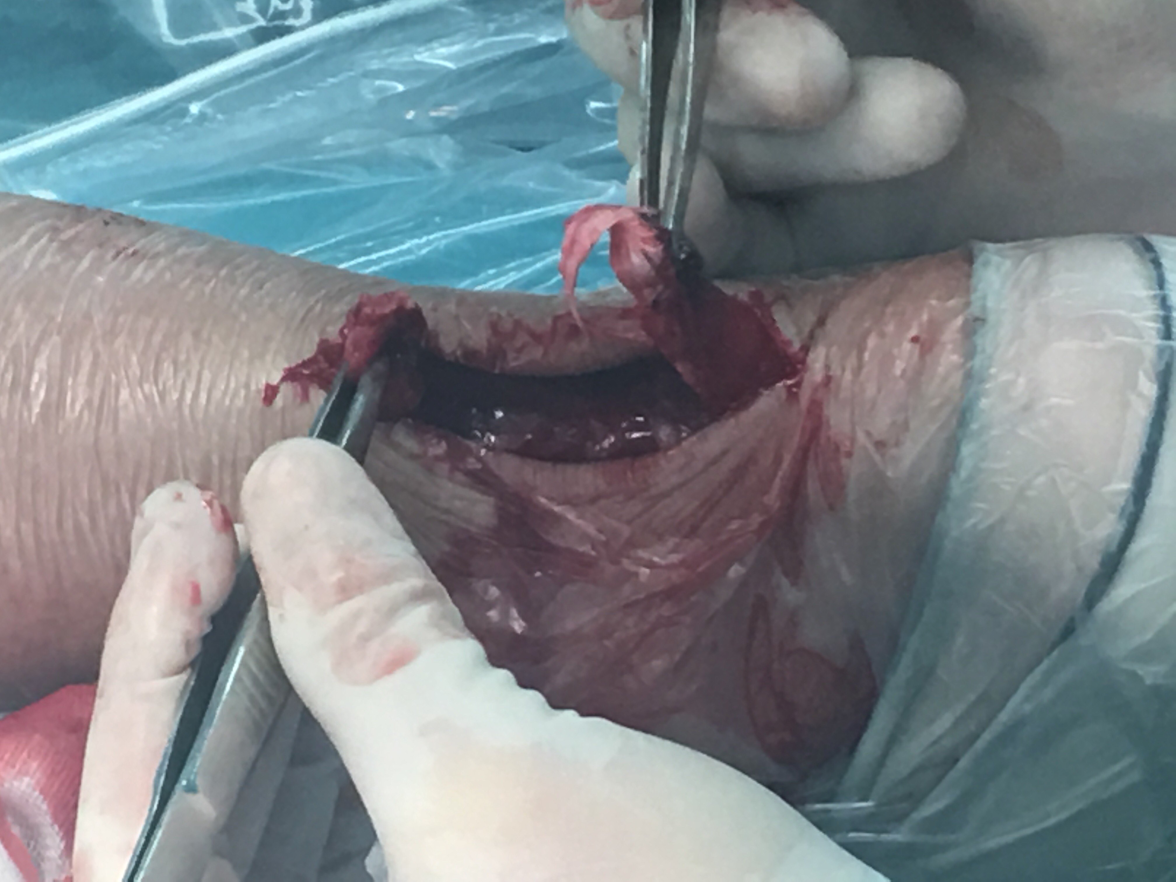 跟腱断裂的图片