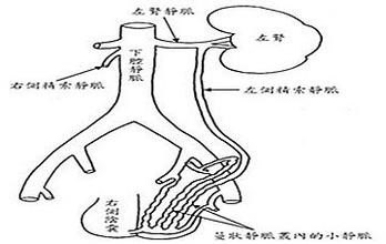 精索静脉曲张的前世今生 