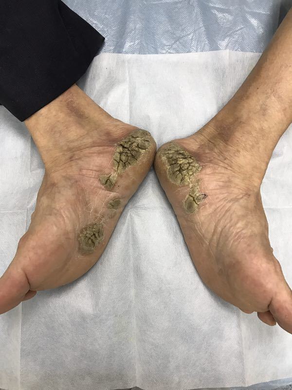 手足皮肤突然增厚,角化,要小心可能是体内有癌