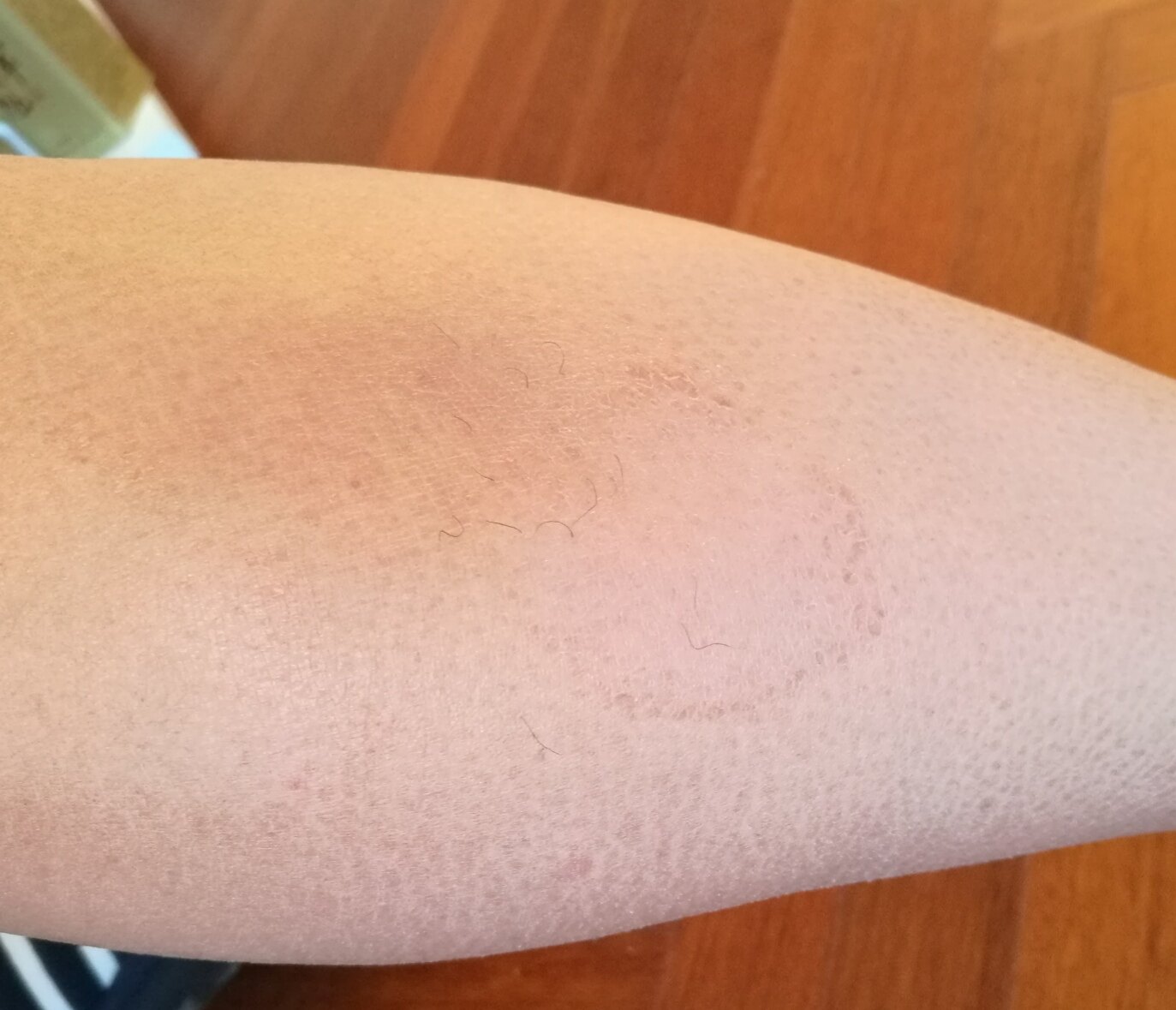 皮炎案 - 好大夫在线