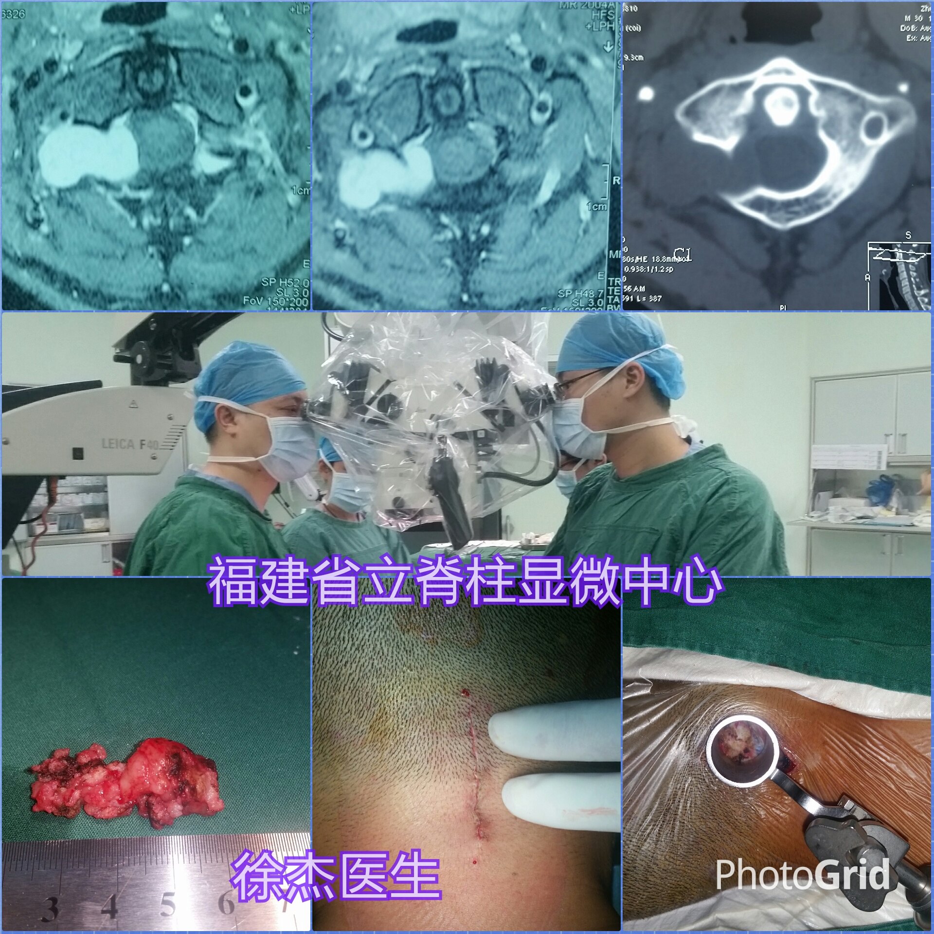 跨椎间孔哑铃形神经鞘瘤15年