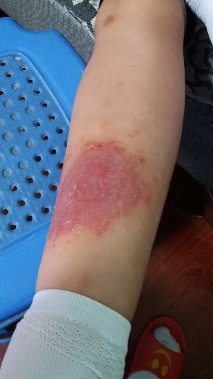 湿疹的多种脸谱