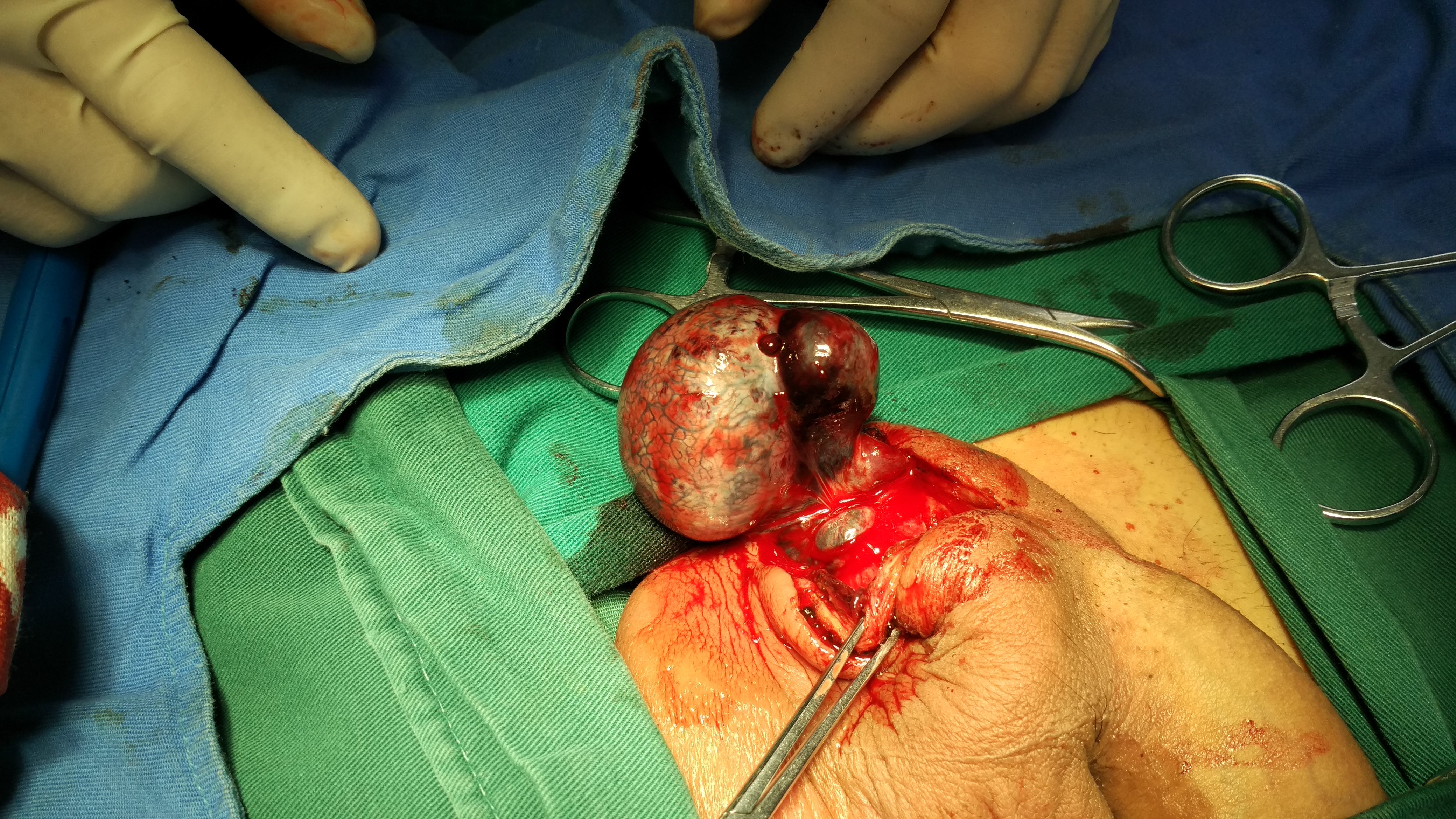 睾丸切除手术图摘除图片
