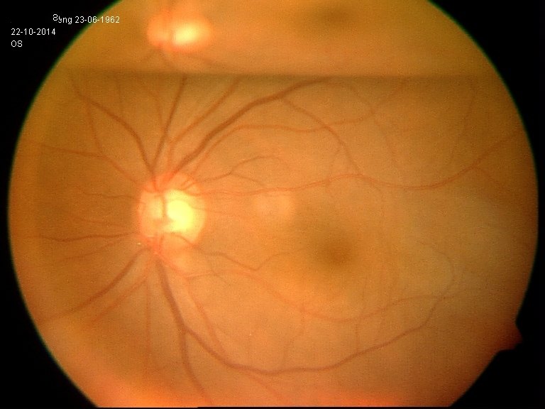 典型病例一孔源性视网膜脱离手术一例
