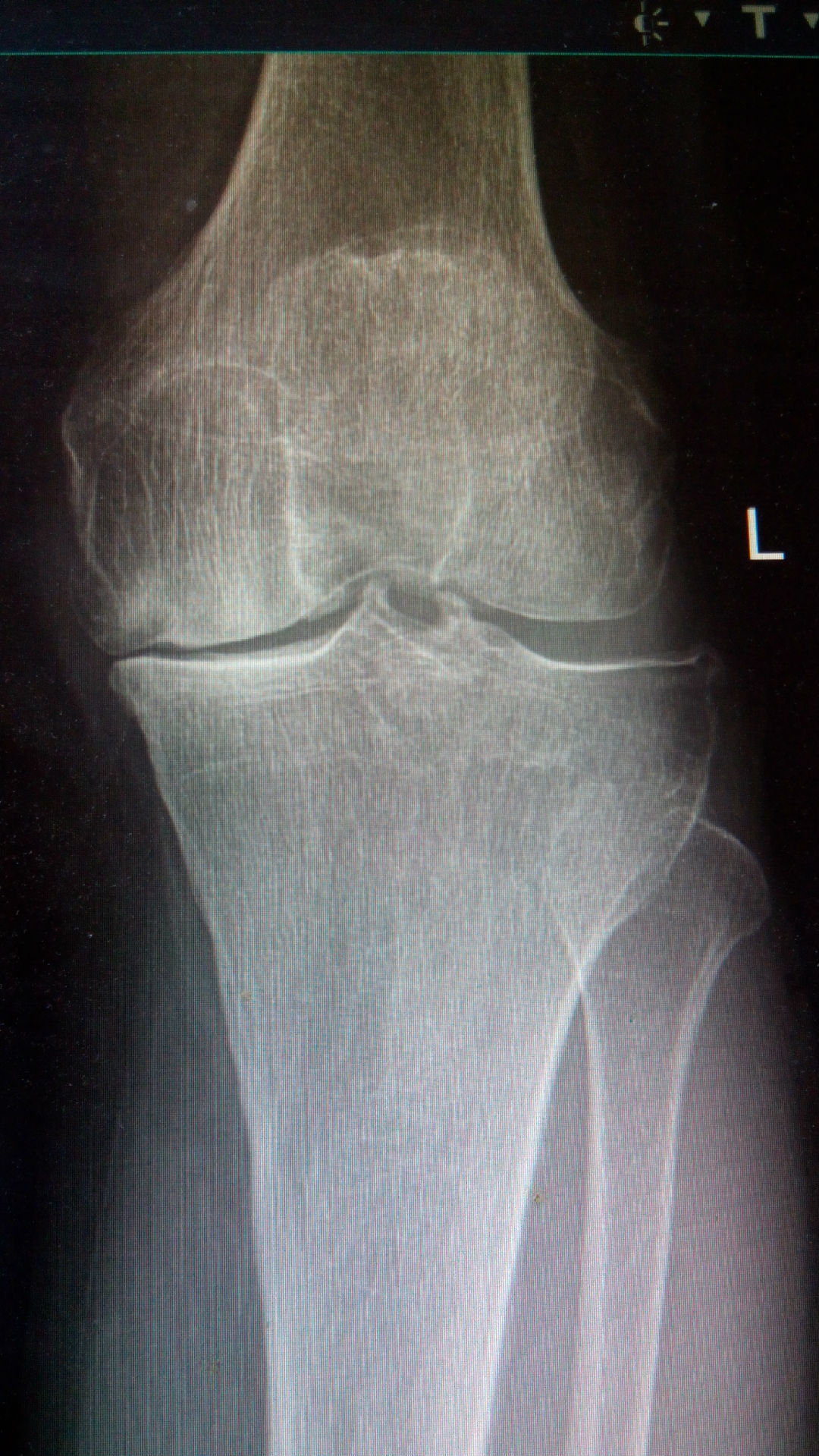 膝关节的结构特点与骨质增生、退型性变。_南通国光中医门诊部