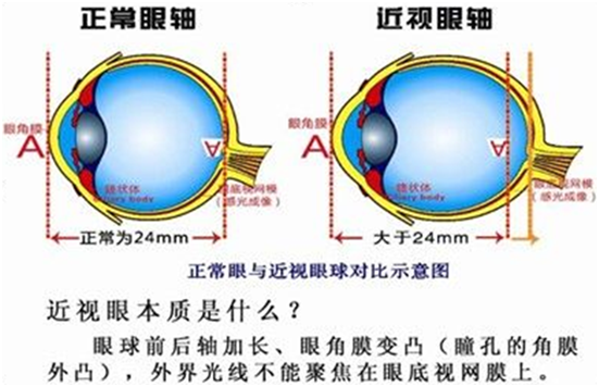 近视眼是怎么形成的?